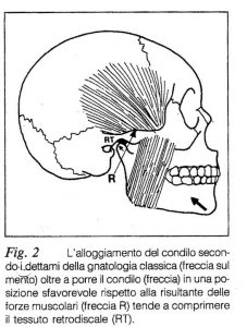 Alloggiamento del condilo secondo i dettami della gnatologia classica