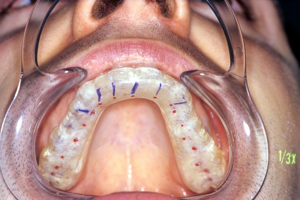 BITE DI STABILIZZAZIONE