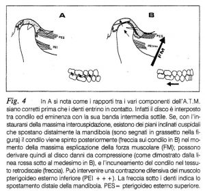 spostamento distale della mandibola