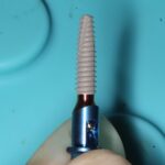 Riabilitazione su 6 impianti protesicamente guidata: approccio flapless full-digital. Realtà o finzione?